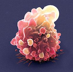 bowelcancercell.jpg